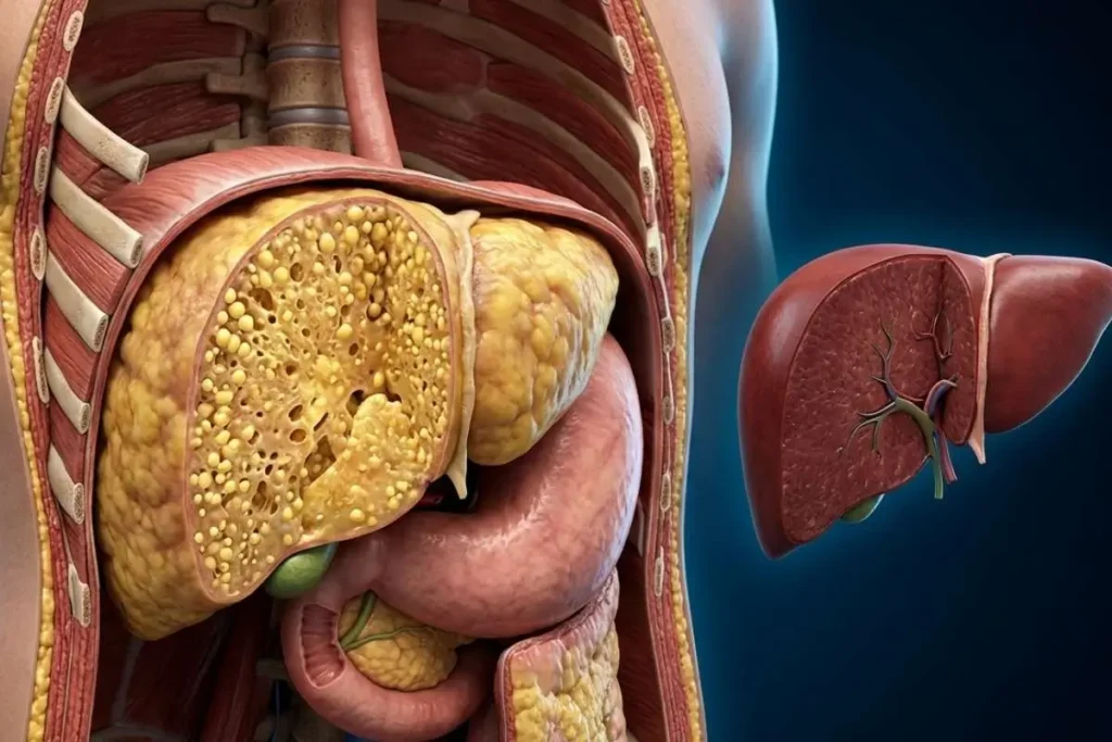 Ilustração 3D do fígado com acúmulo de gordura comparado a fígado saudável representando esteatose hepática